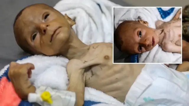 yetersiz beslenme nedeniyle gazzede 2 aylik bebegin yasami tehdit altinda kC65SKRy